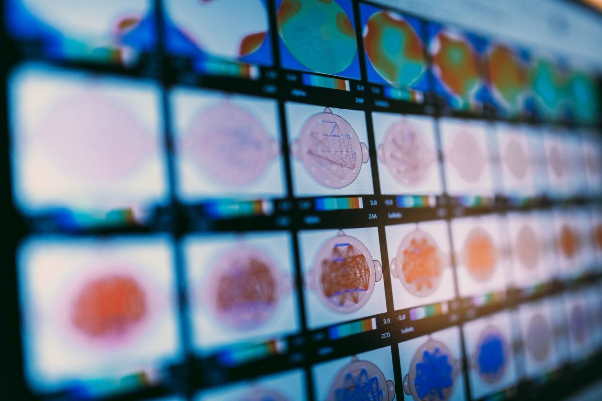 Brain connectivity maps on a QEEG analysis screen