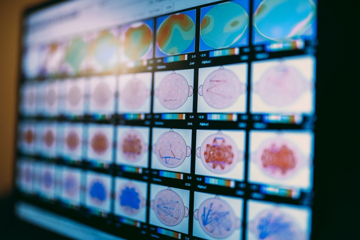 QEEG brain mapping display on a clinical monitor